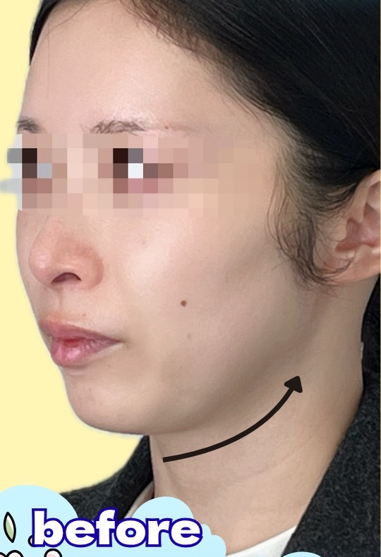 症例写真：脂肪吸引＆糸リフトの施術前