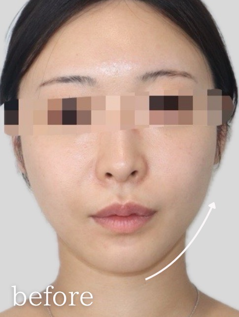 症例写真：糸リフトの施術前01