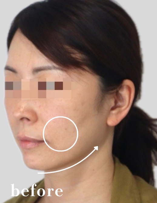 症例写真：糸リフトの施術前03
