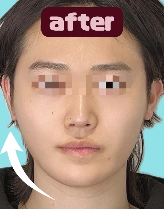 症例写真：糸リフトの施術後04
