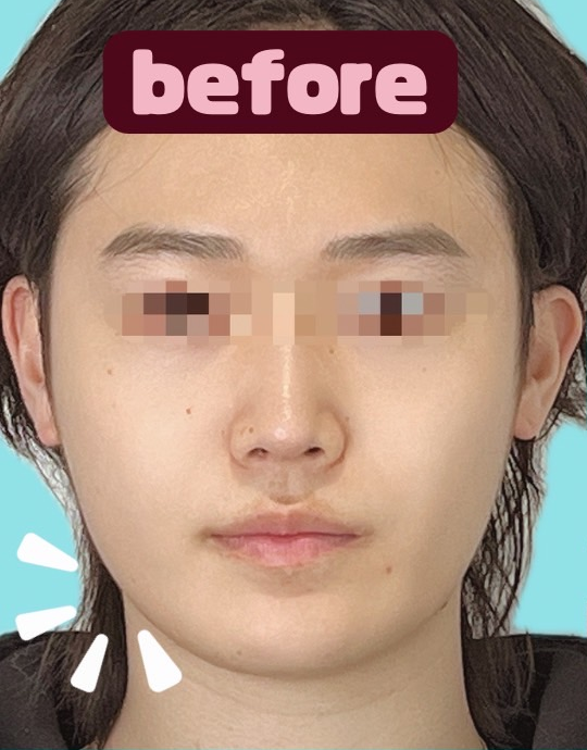 症例写真：糸リフトの施術前04