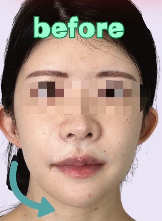 症例写真：糸リフトの施術前05
