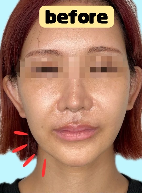 症例写真：糸リフトの施術前08