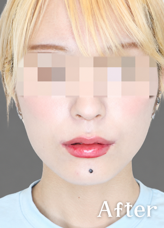 症例写真：口角挙上術の施術後