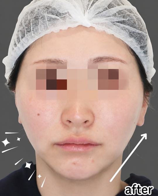 症例写真：糸リフトの施術後01
