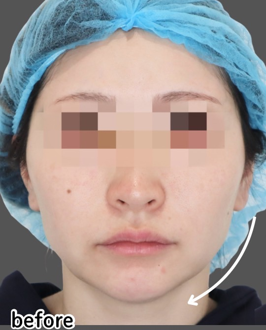 症例写真：糸リフトの施術前01