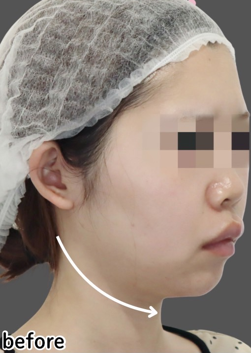 症例写真：糸リフトの施術前02